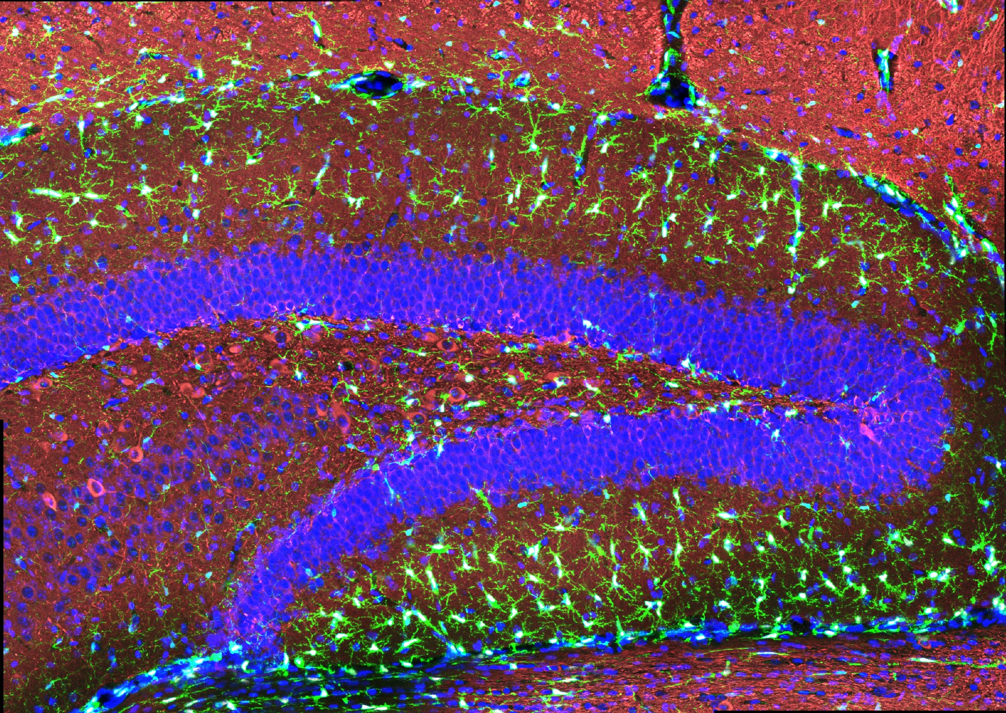 How a mutation in microglia elevates Alzheimer’s risk