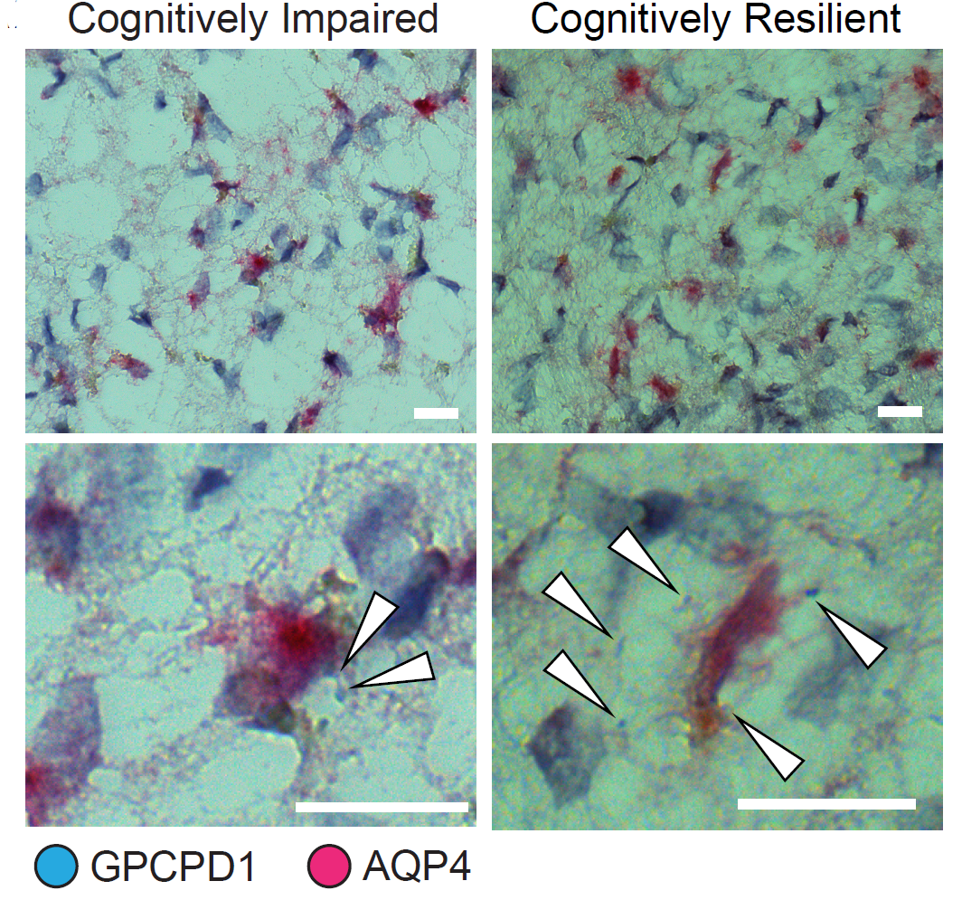 In two columns labeled "Cognitively Impaired" and "Cognitively Resistent" microscope images show astrocyte cells with magenta staining. Small blue dots are visible around some of the astrocyte cells and those dots are indicated by large white arrows.