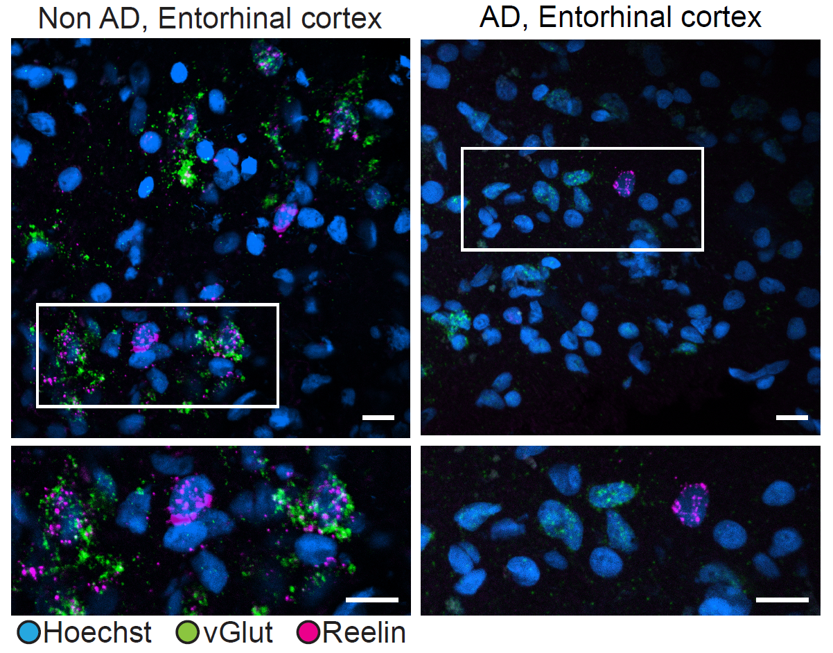 Two panels show blue cells on a black background. Some cells have magenta and green speckles. Below, each panel two subpanels show magnified views.