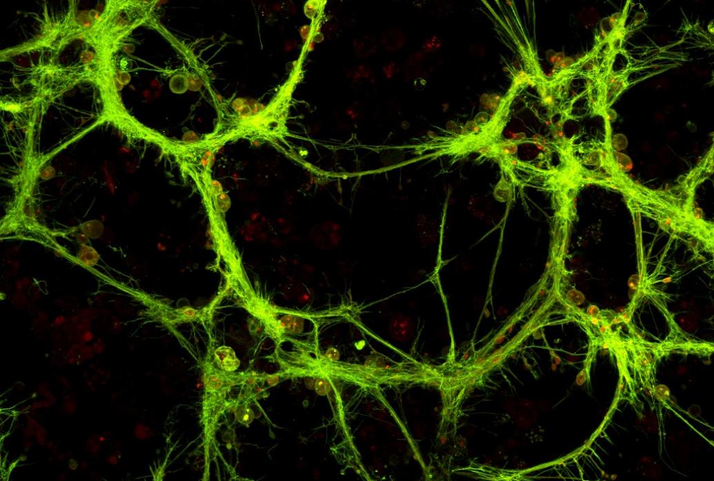 Bright yellow wisps indicate aggregated mutant huntingtin protein.