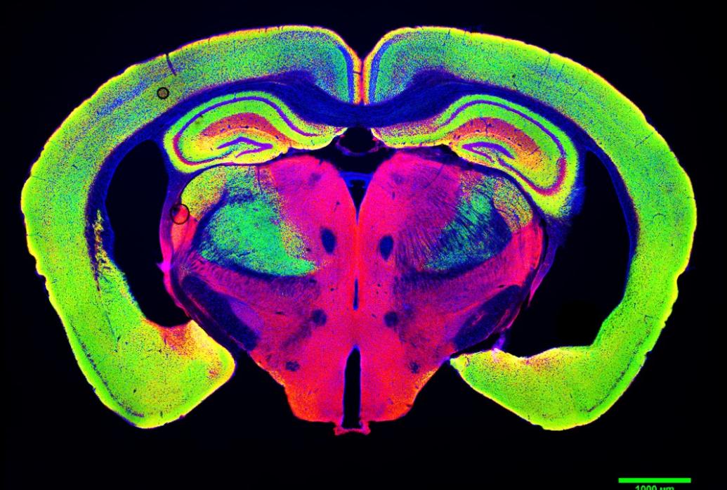 Slice through a mouse brain shows huge ventricles opened up by neurodegeneration in a p25 mouse