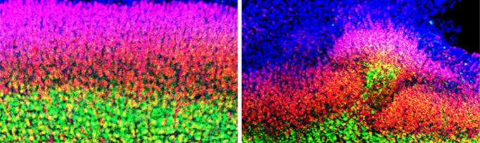 In utero exposure to Il-17a resulted in abnormal cortical development (right).