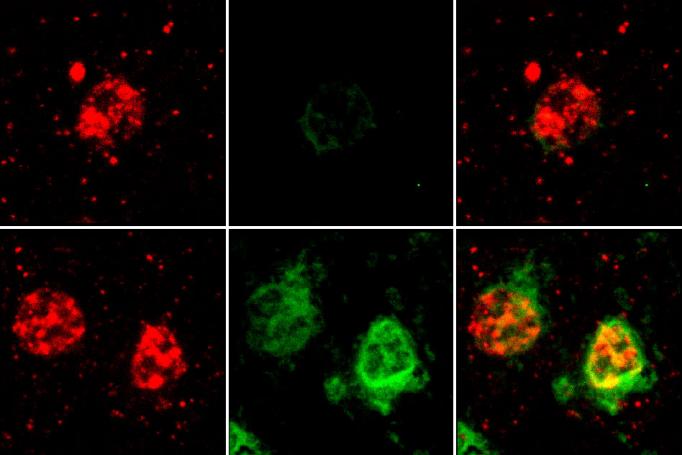 An array of six images shows that oligodendrocytes high in amyloid also express more of two proteins