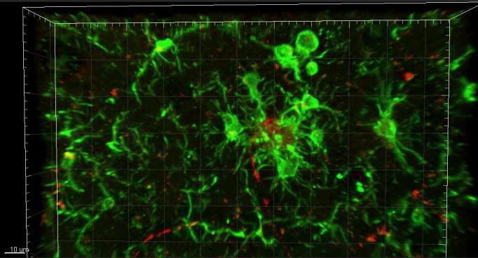 Green microglia cluster around a clump of amyloid beta protein