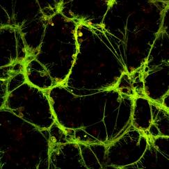 Bright yellow wisps indicate aggregated mutant huntingtin protein.